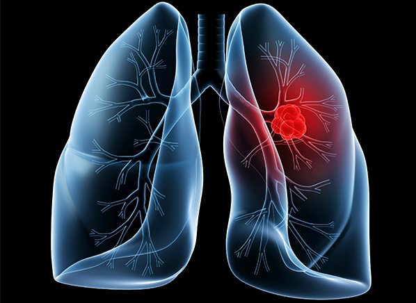 5 Lung Cancer